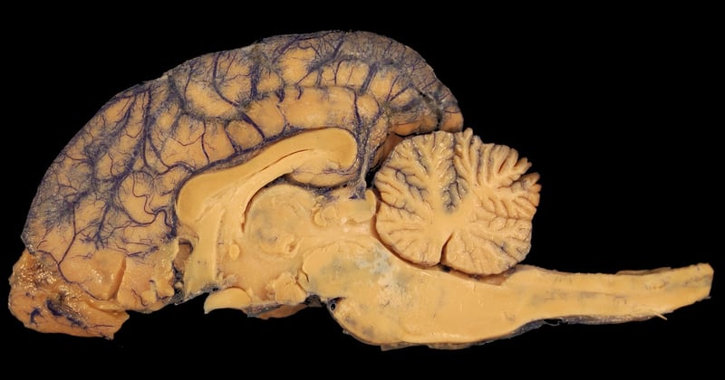 Leucoaraïose : comprendre cette atteinte des petits vaisseaux cérébraux